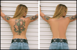 remover tatuaje