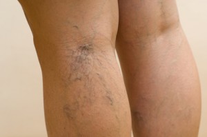 Consejos contra varices y derrames 2