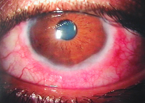 Conjuntivitis 1