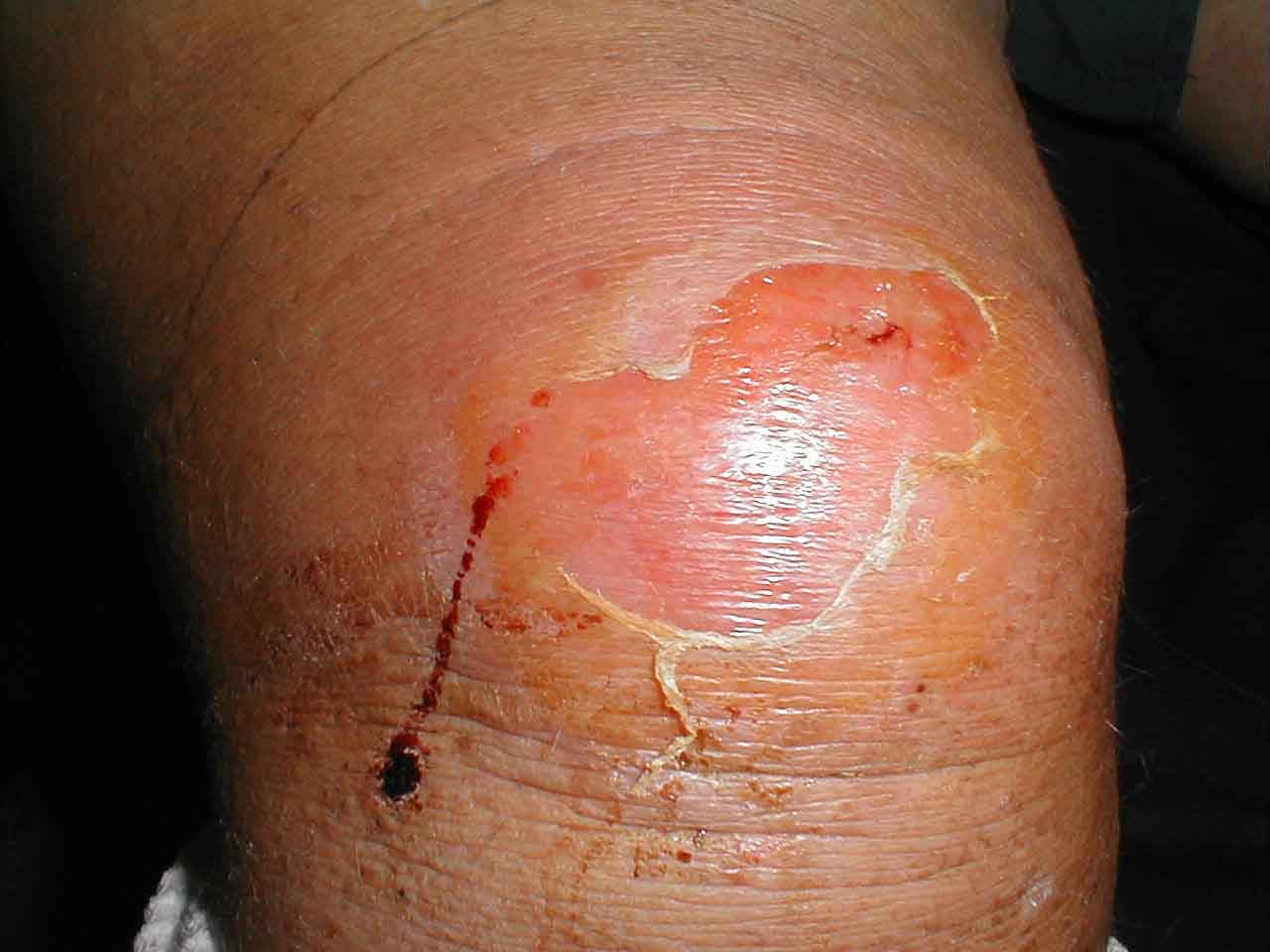 Bursitis (dolor en las rodillas) 1