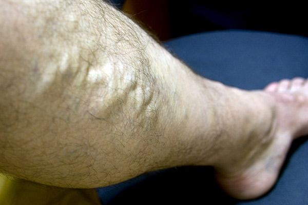 Varices en las piernas 1