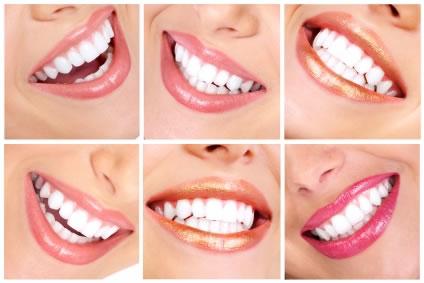 Blanquear los dientes naturalmente 1