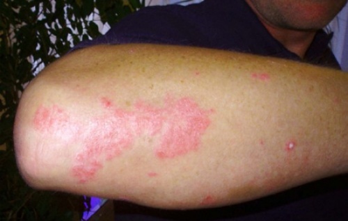 Soluciones para las psoriasis 1