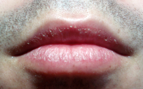 Sequedad labial 1