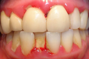 Evitar la Gingivitis como… 6