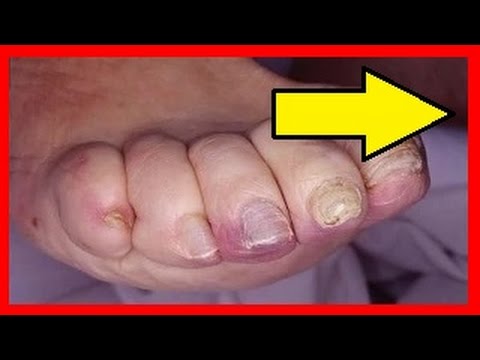 Hongos en los pies