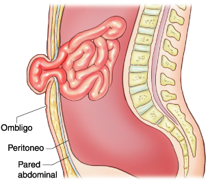complicaciones de una hernia