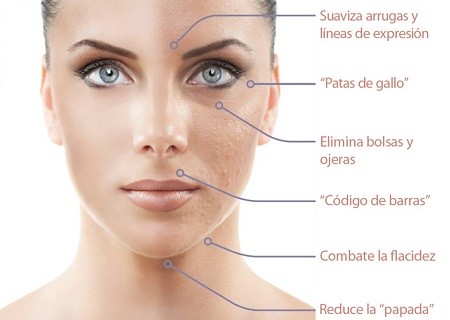 radiofrecuencia facial