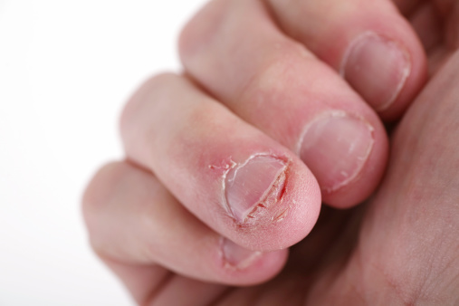 uñas mordidas