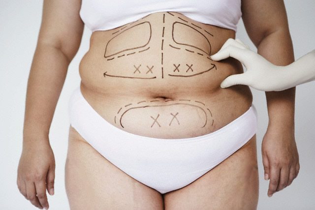 lipoescultura
