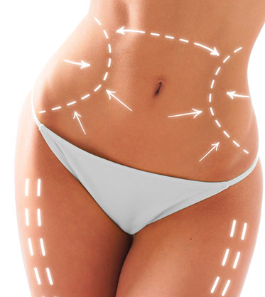 lipoescultura