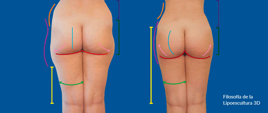 resultado de lipoescultura