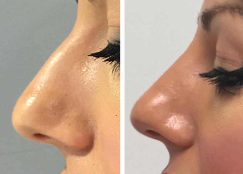 corrección de nariz