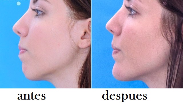 correccion de menton